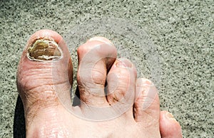 Ugly male feet and toes affected by toe nail fungus and arhtritic hammertoes photo