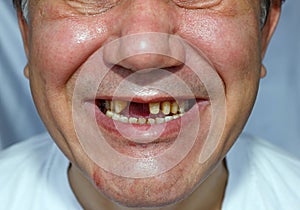 Škaredý muž lúpaný zuby odretý 