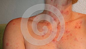 Ugly skin rash photo