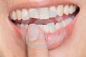 Ugly smile dental problem. Teeth Injuries or Teeth Breaking in Male.