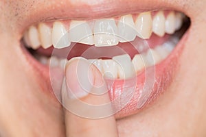 Ugly smile dental problem. Teeth Injuries or Teeth Breaking in Male. photo
