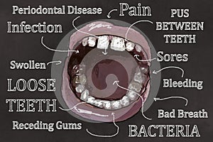 Ugly Teeth, open Mouth and Symptoms of Gum Disease. Illustrated on Blackboard in Classic Drawing Style