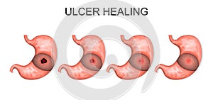 Ulcer healing. gastroenterology