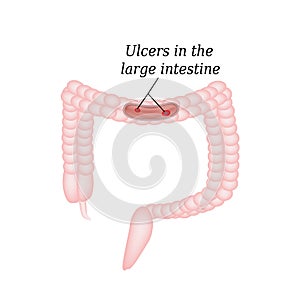 Ulcer in the intestine. Ulcers in the colon