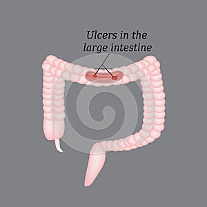 Ulcer in the intestine. Ulcers in the colon