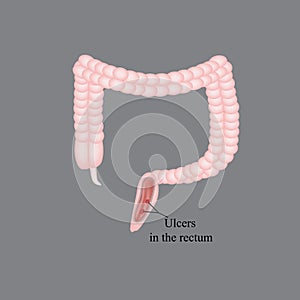 An ulcer in the rectum. Ulcers in the intestines photo