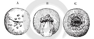 Ulceration of the cervix, vintage engraving