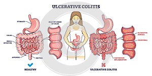 Ulcerative colitis as chronic inflammatory bowel disease outline diagram