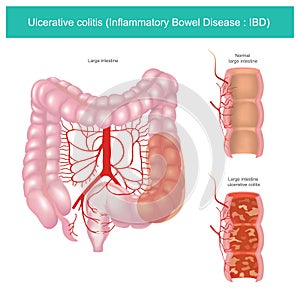 Ulcerative colitis. Illustration graphic. photo