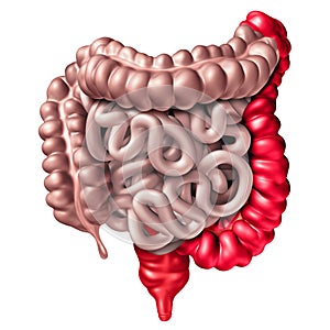 Ulcerative Colitis Digestive Medical Condition