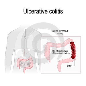 Ulcerative colitis photo