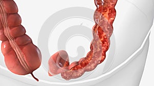 Ulcerative colitis is an inflammatory bowel disease that causes inflammation and ulcers (sores) in your digestive tract