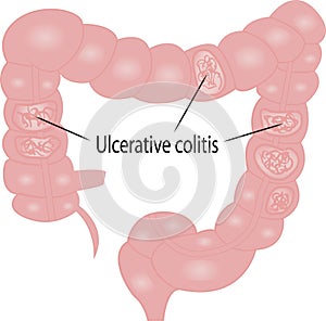 Ulcerative colitis intestine disease