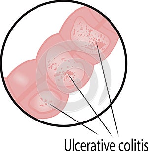 Ulcerative colitis intestine disease photo