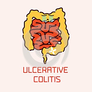 Ulcerative colitis poster