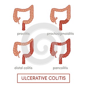 Ulcerative colitis photo
