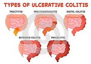 Ulcerative colitis types, gut disease, intestine inflammation from proctitis to pancolitis. Medical vector illustration photo