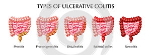Ulcerative Colitis Types Infographics