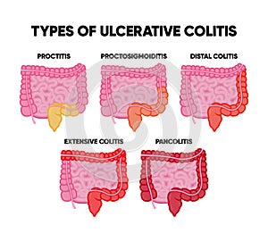 Ulcerative colitis types infographics including proctitis distal colitis pancolitis proctosigmoiditis subtotal colitis photo