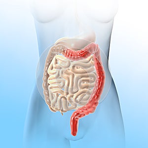 Ulcerative colitis UC, inflammation and ulcers of the colon and rectus, medically illustration