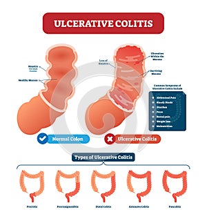 Ulcerative colitis vector illustration. Labeled anatomical infographic