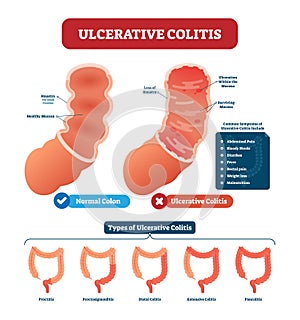 Ulcerative colitis vector illustration. Labeled anatomical infographic photo