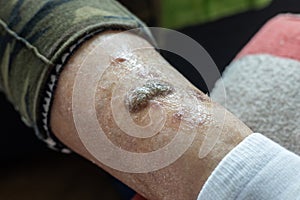 Ulcers and skin diseases, dried scabs and fresh wounds on the legs of an elderly woman, Health concept, senile changes