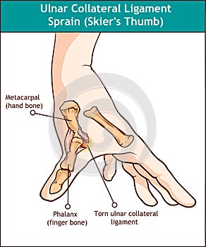 Ulnar Collateral Ligament Sprain Skier`s Thumb photo