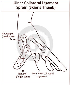 Ulnar Collateral Ligament Sprain Skier`s Thumb