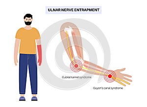 Ulnar nerve entrapment