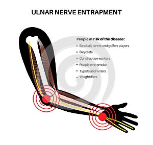 Ulnar nerve entrapment