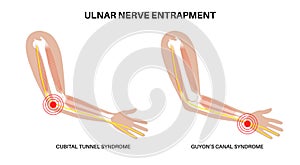 Ulnar nerve entrapment photo