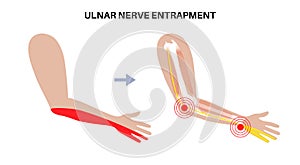 Ulnar nerve entrapment photo