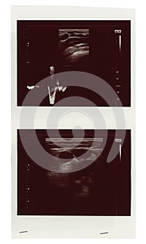 Ultrasonic diagnostic sonography photo