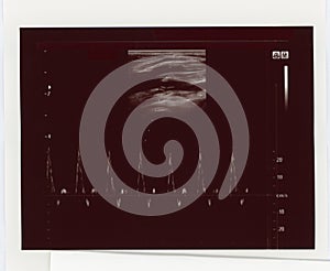 Ultrasonic diagnostic sonography photo