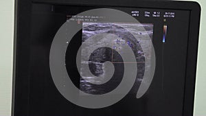Ultrasonic diagnostics. Ultrasound monitor. Monitor with ultrasonic interactive echogram pictures