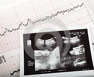 Ultrasonic result of the fetus and cardiogram of the baby photo