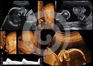 Ultrasonographic Photos from a Baby