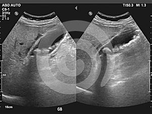 Ultrasonography image of gallbladder with gall stones at upper abdomen