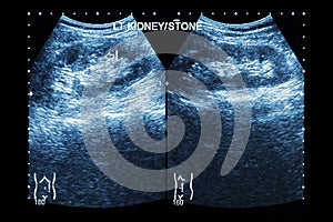 Ultrasonography of kidney : show left kidney stone ( 2 image for compare )