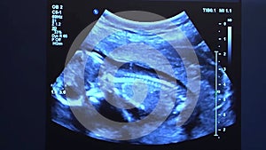 Ultrasonography of pregnant woman.