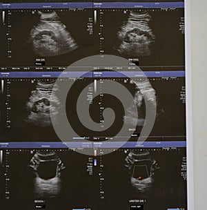 Ultrasonography of the upper abdomen with visualized portions of various organs, zoom