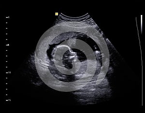 Ultrasound Baby photo