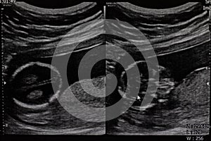 Ultrasound of baby in mother