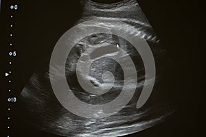 Ultrasound photo of unborn baby in mother`s womb, closeup view