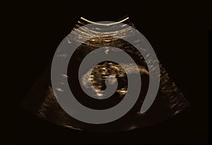 Ultrasound of baby in pregnant woman