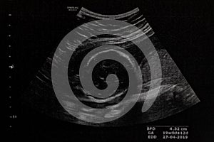 Ultrasound of baby in mother`s at hospital.