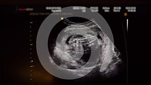 Ultrasound Of Baby In The Womb In The Second Trimester