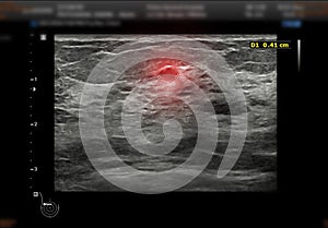 ultrasound  breast of Patient after mammogram  for diagnonsis Breast cancer in women isolated on black background