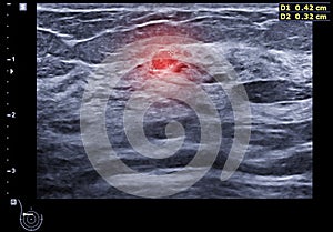 ultrasound  breast of Patient after mammogram  for diagnonsis Breast cancer in women isolated on black background